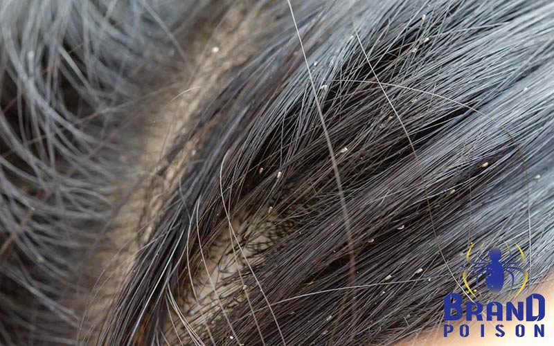 شپش یک مساله بهداشتی حائز اهمیت 2 علائم و نشانه های ابتلا به شپش