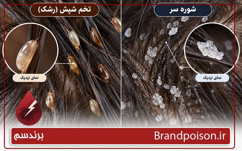 چگونه می توان تخم های شپش را شناسایی کرد؟ 5 نشانه اصلی 3 فرق شوره با تخم شپش